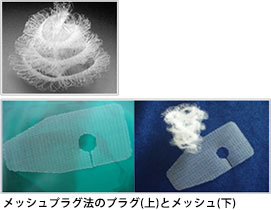 メッシュプラグ法のプラグ(上)とメッシュ(下)